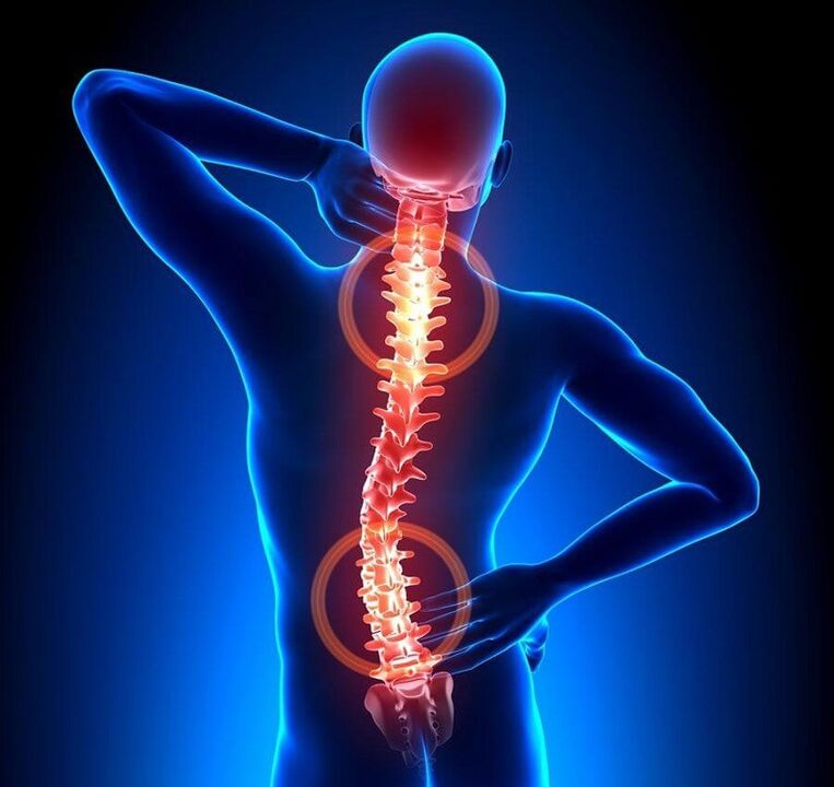 stuburo osteochondrozė kaip nugaros skausmo priežastis