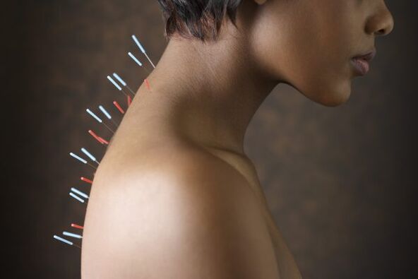 akupunktūra nugaros skausmui