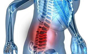 Juosmens osteochondrozės požymiai ir simptomai